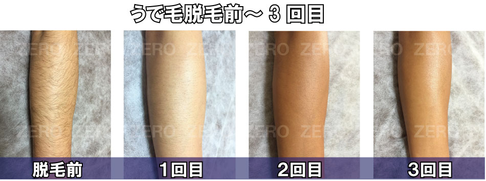 うで毛脱毛前～3回目