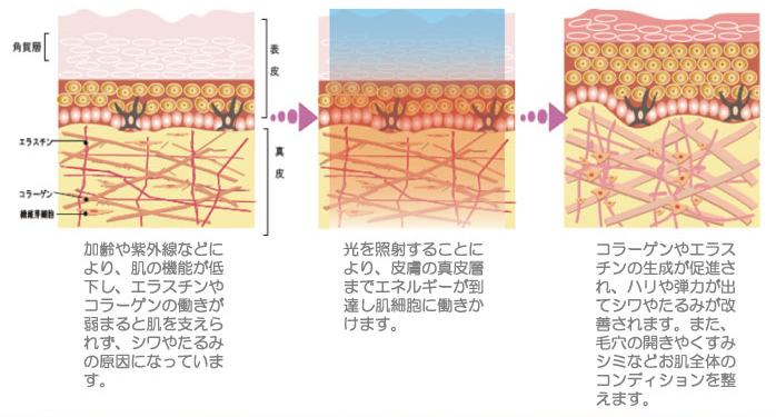 メンズ光フェイシャルとは？