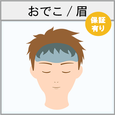 おでこ・眉間の脱毛範囲画像