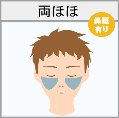 両ほほの脱毛範囲画像