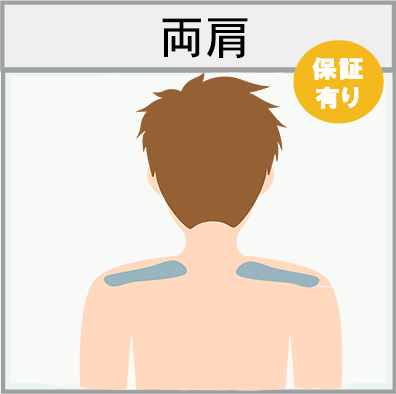 両肩の脱毛範囲画像