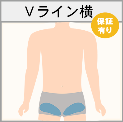 Vライン横の脱毛範囲画像