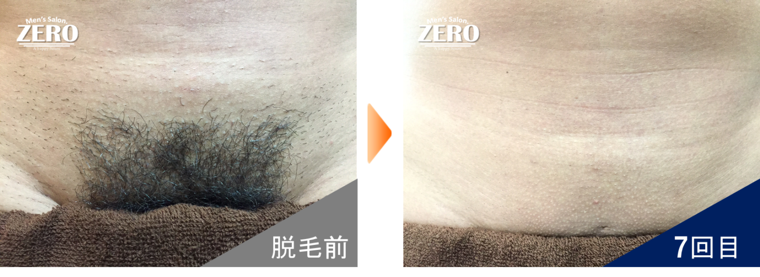 ビフォーアフター