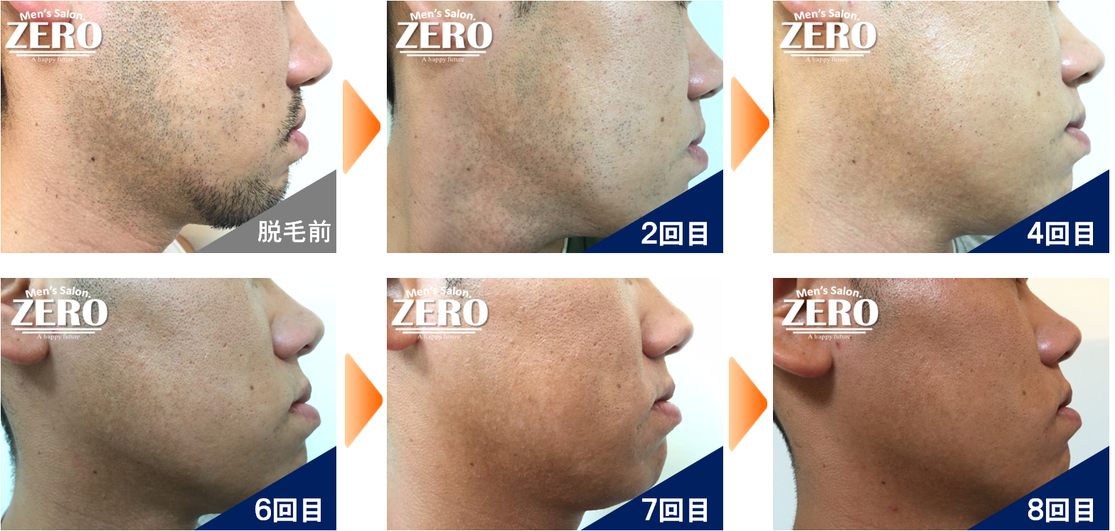 30代前半男性 側面　≪頬・あご裏・もみあげ・フェイスライン脱毛≫