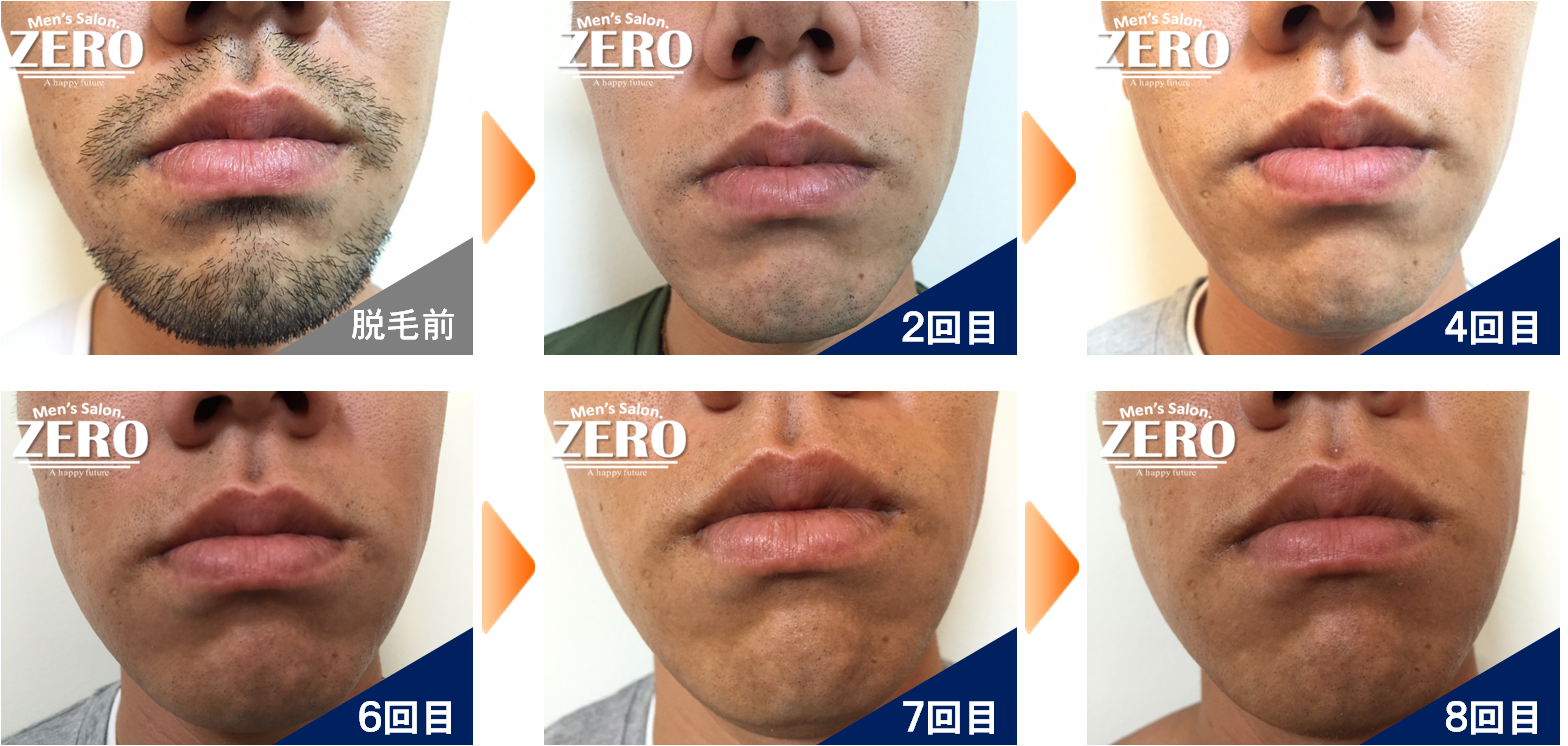 30代前半男性 正面　≪鼻下・あご脱毛≫