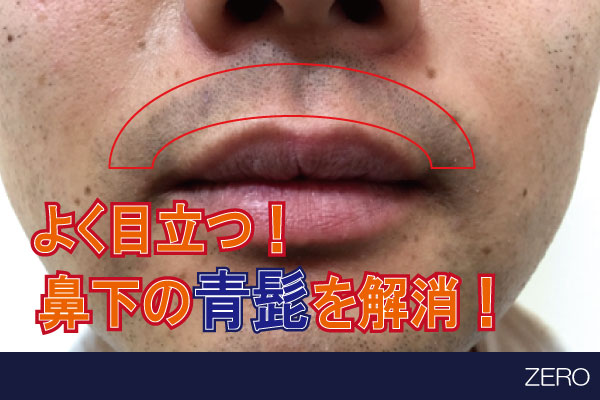 よく目立つ青髭を解消！人気の鼻下脱毛