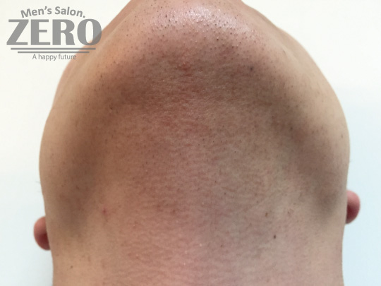 ZEROヒゲ脱毛結果写真・効果写真。心斎橋5　あご裏側4回目≪鼻下・あご・両ほほ・フェイスライン・あご裏・首周り脱毛≫
