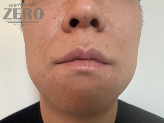 ZEROヒゲ脱毛結果写真・効果写真。心斎橋6　正面10回目≪両ほほ・鼻下・フェイスライン・もみあげ・あご・あご裏・首周り脱毛≫