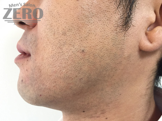 ZEROヒゲ脱毛結果写真・効果写真。心斎橋6　横顔施術前≪両ほほ・鼻下・フェイスライン・もみあげ・あご・あご裏・首周り脱毛≫