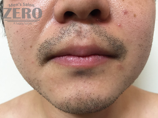ZEROヒゲ脱毛結果写真・効果写真。心斎橋7　正面施術前≪両頬・鼻下・フェイスライン・あご・あご裏・ももあげ・首周り脱毛≫