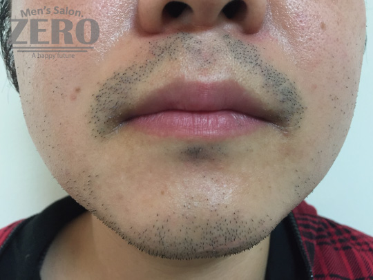 ZEROヒゲ脱毛結果写真・効果写真。心斎橋7　正面1回目≪両頬・鼻下・フェイスライン・あご・あご裏・ももあげ・首周り脱毛≫