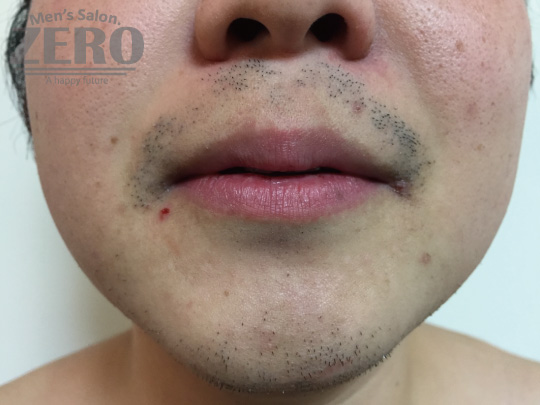 ZEROヒゲ脱毛結果写真・効果写真。心斎橋7　正面6回目≪両頬・鼻下・フェイスライン・あご・あご裏・ももあげ・首周り脱毛≫