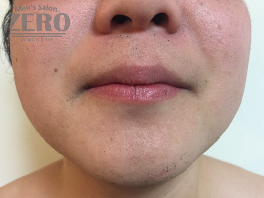 ZEROヒゲ脱毛結果写真・効果写真。心斎橋7　正面8回目≪両頬・鼻下・フェイスライン・あご・あご裏・ももあげ・首周り脱毛≫
