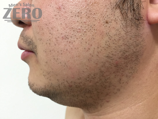 ZEROヒゲ脱毛結果写真・効果写真。心斎橋7　横顔施術前≪両頬・鼻下・フェイスライン・あご・あご裏・ももあげ・首周り脱毛≫