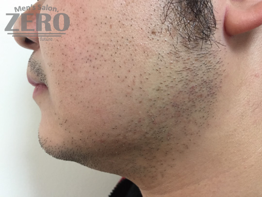 ZEROヒゲ脱毛結果写真・効果写真。心斎橋7　横顔1回目≪両頬・鼻下・フェイスライン・あご・あご裏・ももあげ・首周り脱毛≫