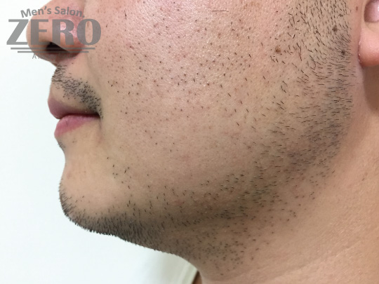 ZEROヒゲ脱毛結果写真・効果写真。心斎橋7　横顔2回目≪両頬・鼻下・フェイスライン・あご・あご裏・ももあげ・首周り脱毛≫