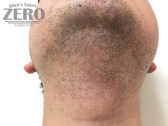 ZEROヒゲ脱毛結果写真・効果写真。心斎橋7　あご裏・首周り脱毛2回目≪鼻下・あご・両ほほ・フェイスライン・あご裏・首周り脱毛≫
