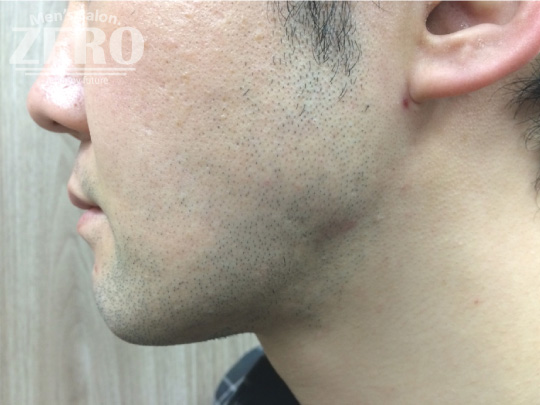 ZEROヒゲ脱毛結果写真・効果写真。心斎橋3　あご裏側2回目≪鼻下・あご・両ほほ・フェイスライン・あご裏・首周り脱毛≫
