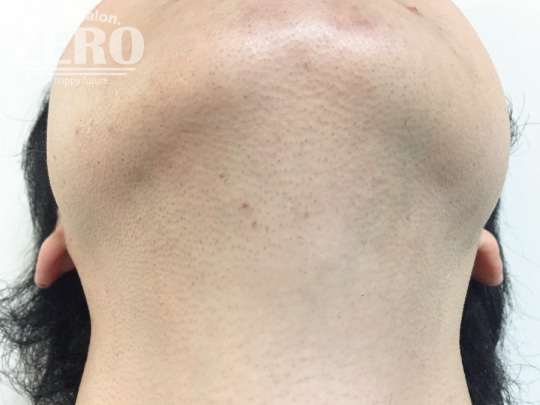 ZEROヒゲ脱毛結果写真・効果写真。心斎橋3　あご裏側9回目≪鼻下・あご・両ほほ・フェイスライン・あご裏・首周り脱毛≫