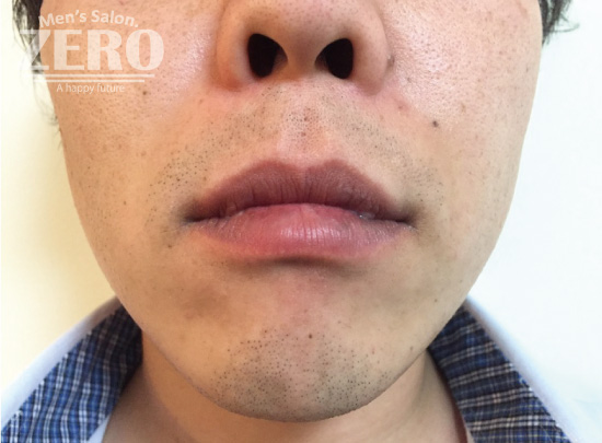 ZEROヒゲ脱毛結果写真・効果写真。心斎橋5　正面施術前≪両ほほ・鼻下・フェイスライン・あご・あご裏脱毛≫