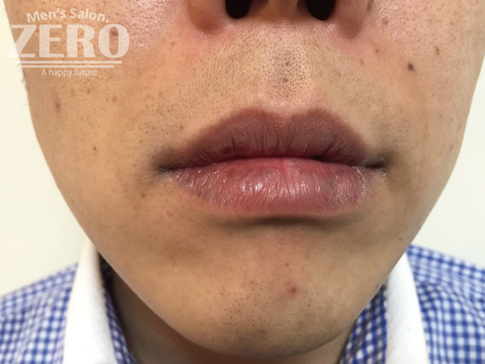 ZEROヒゲ脱毛結果写真・効果写真。心斎橋5　正面4回目≪両ほほ・鼻下・フェイスライン・あご・あご裏脱毛≫