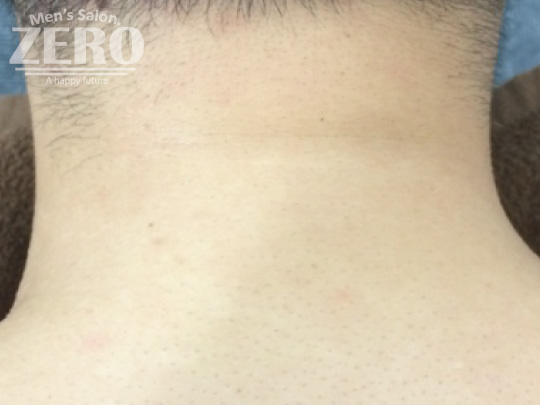 ZEROうなじ襟足脱毛結果写真・効果写真。大阪心斎橋1　脱毛4回目写真≪うなじ襟足脱毛≫
