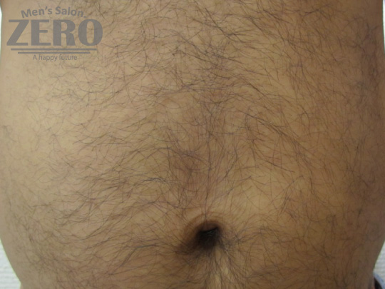 ZEROメンズお腹脱毛結果写真・効果写真。大阪心斎橋2お腹全体脱毛施術前写真≪腹毛・ギャランドゥ脱毛≫