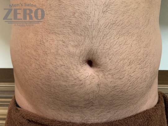 ZEROメンズお腹脱毛結果写真・効果写真。大阪心斎橋3お腹全体脱毛施術前写真≪腹毛・ギャランドゥ脱毛≫