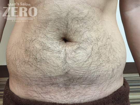 ZEROメンズお腹脱毛結果写真・効果写真。大阪心斎橋4お腹全体脱毛施術前写真≪腹毛・ギャランドゥ脱毛≫