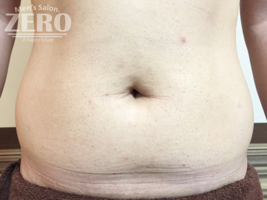 ZEROメンズお腹脱毛結果写真・効果写真。大阪心斎橋4お腹全体脱毛3回目写真≪腹毛・ギャランドゥ脱毛≫