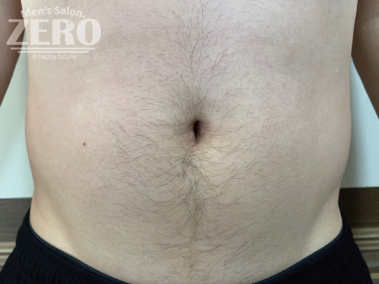 ZEROメンズお腹脱毛結果写真・効果写真。大阪心斎橋7、お腹全体脱毛施術前写真≪腹毛・ギャランドゥ脱毛≫
