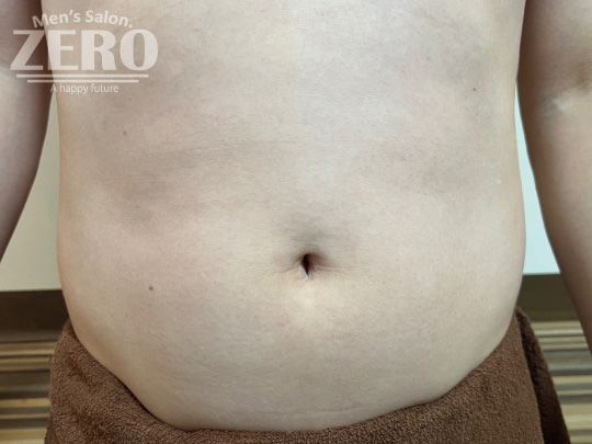ZEROメンズお腹脱毛結果写真・効果写真。大阪心斎橋7、お腹全体脱毛5回目写真≪腹毛・ギャランドゥ脱毛≫
