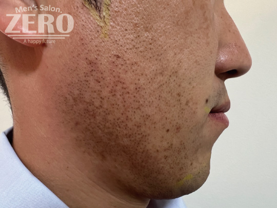 ZEROヒゲ脱毛結果写真・効果写真。心斎橋22-2　横顔脱毛施術2回目≪両ほほ・フェイスライン・もみあげ・あご・あご裏・首周りのデザイン髭脱毛≫