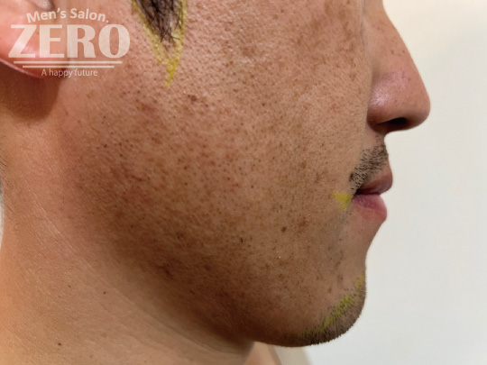 ZEROヒゲ脱毛結果写真・効果写真。心斎橋22-3　横顔脱毛施術3回目≪両ほほ・フェイスライン・もみあげ・あご・あご裏・首周りのデザイン髭脱毛≫