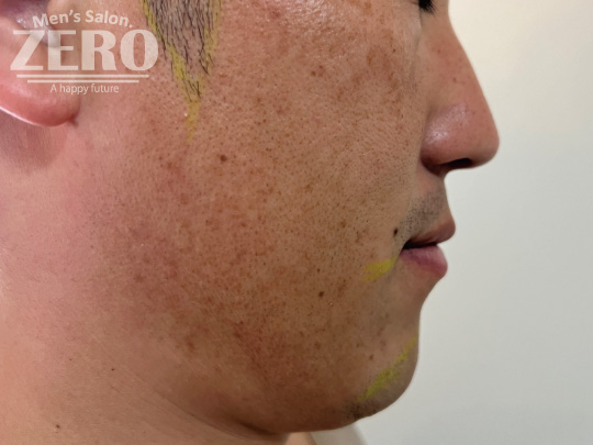 ZEROヒゲ脱毛結果写真・効果写真。心斎橋22-4　横顔脱毛施術4回目≪両ほほ・フェイスライン・もみあげ・あご・あご裏・首周りのデザイン髭脱毛≫